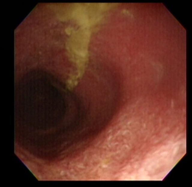 炎症性腸疾患