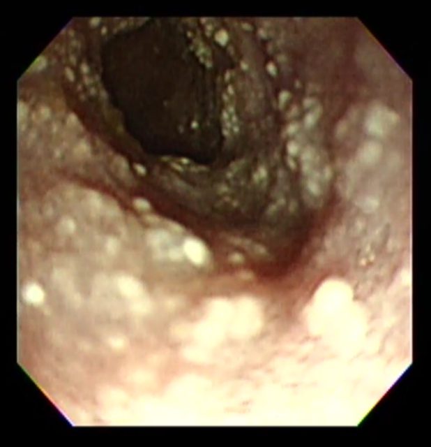 腸リンパ管拡張症2